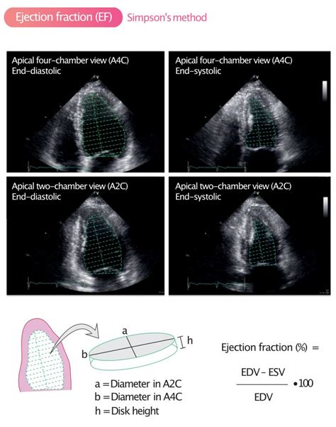 ef hjerte|Ejection Fraction Heart Failure Measurement